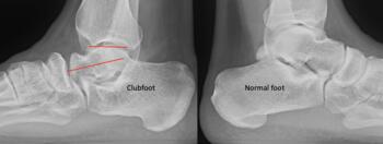 Congenital clubfoot has a shorter and wider talus.  The ankle joint surface is far shorter than the normal ankle joint as compared to the contra-lateral side in this case.  More often the navicular becomes deformed.  Soldier was medically discharged.  