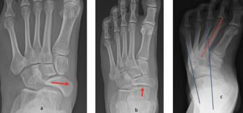 All Soldiers who were medically discharged. a. Medially displaced navicular due to tight posterior tibial tendon (Turco release) b, Flattened talar head due to jamming as a result of equinus (Cincinnati) c. Residual met adductus and almost parallel talocalcaneal angle (Turco release)