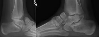 Both these cases show abnormal midtarsal alignment in soldiers post posteriomedial (Turco) releases. 
