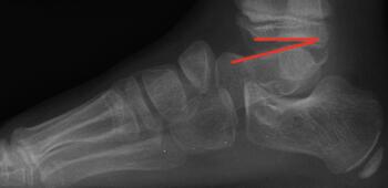 This radiographic image shows a classic flat top talus in a seven-year-old who had a Ponseti.  