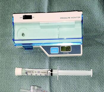 In this photo, one can see the system used to measure compartmental pressures. A 2010 study characterized exercise-induced compartment syndrome as an underdiagnosed condition, with an average delay in diagnosis of 22 months.