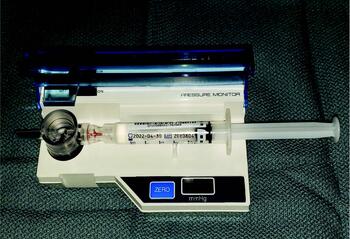 The second preparatory step is to insert the saline flush syringe, as seen in this photo. When suspecting exercise-induced compartment syndrome, the author does not advocate for universally testing pressures right away.