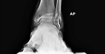 When formulating a plan for total ankle replacement to address ankle arthritis, the authors advocate for surgeons to exercise caution and to not blindly trust engineer-provided preoperative plans for patient-specific instrumentation TAR systems. (Photo courtesy of Jeffrey McAlister, DPM)