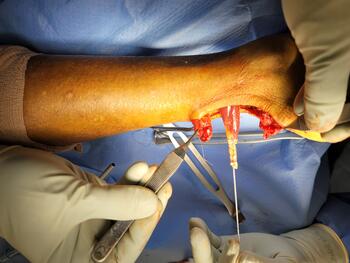  Due to its small lever arm, FHL has minute rotational effect on the ankle and therefore will not have significant influence on the biomechanics of the rearfoot.