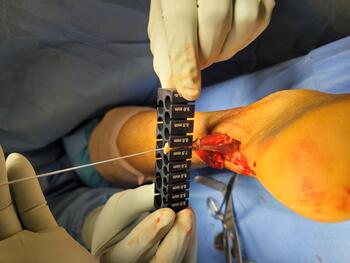 Compared with other transfers, the FHL adds thickness to the anterior portion of the Achilles tendon, which can prevent late problems with incision.