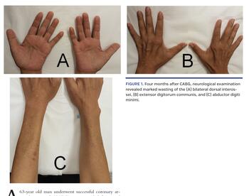 Bilateral Hand Wasting
