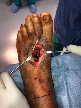 A sagittal saw resected an approximately five cm section of the severe comminution and non-viable bone.