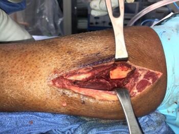 In this photo, a sagittal saw helped harvest fibula graft to fit the previously measured deficit