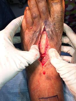 After prepping the distal and proximal aspect of the remaining neck and base of the second metatarsal, the fibular graft was pressed and fitted into the defect.