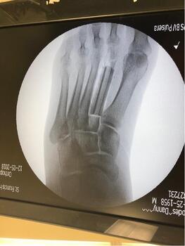 Once confirmed that the graft was the appropriate length to fit the deficit, we brought the graft to the back table, where we fixated a Y-plate to the graft to allow for ease of placement and fixation of the graft to the remaining bone fragments