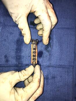 Once confirmed that the graft was the appropriate length to fit the deficit, we brought the graft to the back table, where we fixated a Y-plate to the graft to allow for ease of placement and fixation of the graft to the remaining bone fragments.