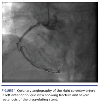 Coronary angiography