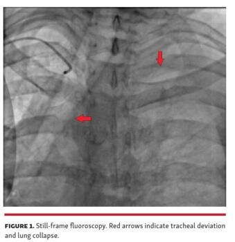 Figure 1. Still-frame fluoroscopy. Red arrows indicate tracheal deviation and lung collapse.