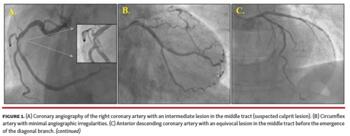 Coronary angiography of the right coronary artery