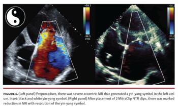 Figure 1. (Left panel) Preprocedure, there was severe eccentric MR that generated a yin-yang symbol in the left atrium. Inset: black and white yin-yang symbol. (Right panel) After placement of 2 MitraClip NTR clips, there was marked reduction in MR with resolution of the yin-yang symbol.