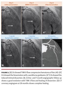 Figure 1. (A) CA showed TIMI 0 flow compressive hematoma of the LAD. (A’) CA showed the fenestration with a workhorse guidewire. (A’’) CA showed the induced intimal dissection. (B, C) One- and 7-month angiographic follow-up shows a good evolution with TIMI 3 flow and healing of