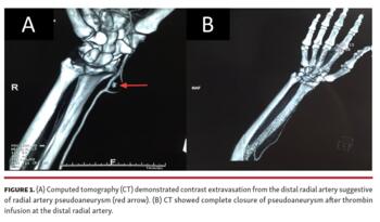 Figure 1. (A) Computed tomography (CT) demonstrated contrast extravasation from the distal radial artery