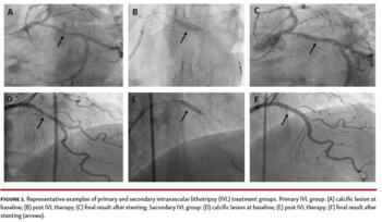 Figure 1. Representative examples of primary and secondary intravascular lithotripsy (IVL) treatment groups. Primary IVL group: (A) calcific lesion at baseline; (B) post IVL therapy; (C) final result after stenting. Secondary IVL group: (D) calcific lesion at baseline; (E) post IVL therapy; (F) final result after stenting (arrows).