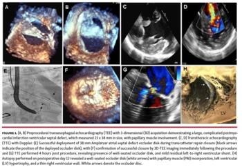 Preprocedural transesophageal echocardiography
