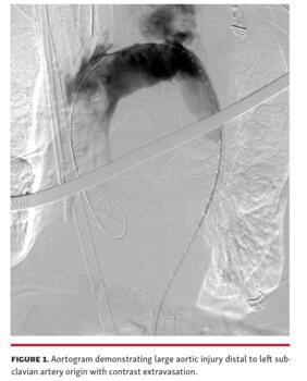 Aortogram demonstrating large aortic injury distal to left subclavian artery origin with contrast extravasation.