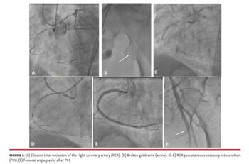 Chronic total occlusion of the right coronary artery