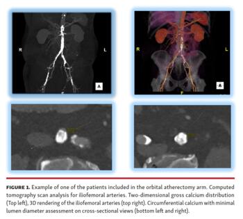 Example of one of the patients included in the orbital atherectomy arm.