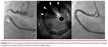 Coronary angiogram