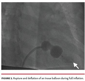 Rupture and deflation of an Inoue balloon during full inflation.
