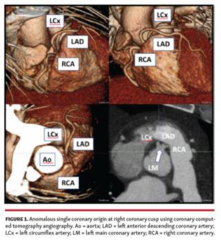 Anomalous single coronary origin at right coronary cusp