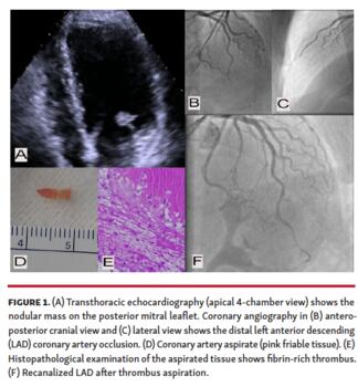 Transthoracic echocardiography