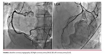 Baseline coronary angiography.
