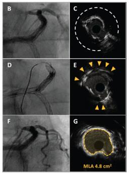 Figure 1. (continued) (C) IVUS demonstrates extensive circumferential calcification (dashed line) with minimal luminal area of 2.5