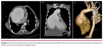 Figure 1. (C, D) Contrast-enhanced computed tomography confirmed aneurysmal dilation of the aortic root and proximal part of the ascending aorta. (E) 3D reconstructed computed tomography image.