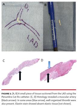 Figure 1. (A, B) A small piece of tissue suctioned from the LAD using the Penumbra Cat Rx catheter. (C, D) Histology revealed a muscular artery (black arrows). In some areas (blue arrow), well-organized thrombi were also present. Elastin stain showed absent elastic tissue (not shown).