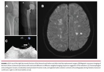 Figure 1. (A) X-ray of the right hip reveals fracture of the femoral neck before and after total hip replacement surgery. (B) Magnetic resonance imaging of the brain shows scattered spot lesions with restricted diffusion on diffusion-weighted imaging sequences suggestive of fat embolism. (C) Transesophageal echocardiogram reveals a moderately sized persistent foramen ovale, and agitated saline solution contrast echocardiography during Valsalva maneuver confirmed a right-to-left shunt (white arrow).