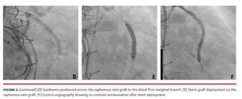 Figure 1. (continued) (D) Guidewire positioned across the saphenous vein graft to the distal first marginal branch. (E) Stent-graft deployment on the saphenous vein graft. (F) Control angiography showing no contrast extravasation after stent deployment.
