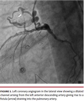 Figure 1. Left coronary angiogram in the lateral view showing a dilated channel arising from the left anterior descending artery giving rise to a fistula (arrow) draining into the pulmonary artery.