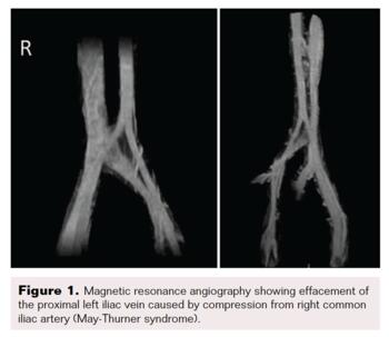FIg 1. May-Thurner syndrome