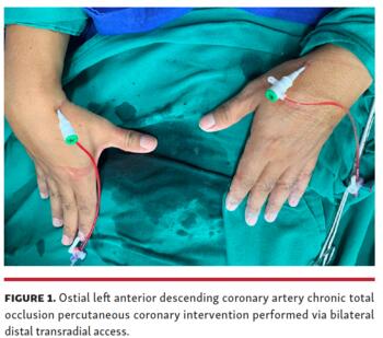 Figure 1. Ostial left anterior descending coronary artery chronic total occlusion percutaneous coronary intervention performed via bilateral distal transradial access.