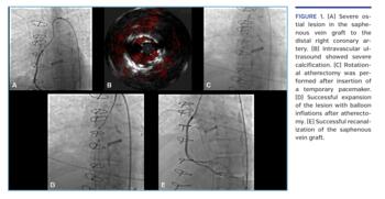 Severe ostial lesion in the saphenous vein graft to the distal right coronary artery.