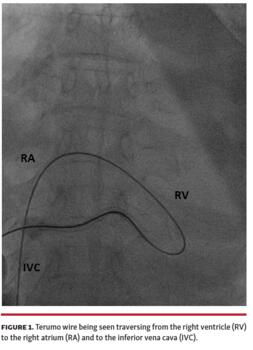 Figure 1. Terumo wire being seen traversing from the right ventricle (RV) to the right atrium (RA) and to the inferior vena cava (IVC).