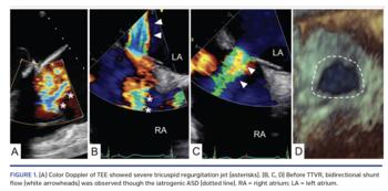 (A) Color Doppler of TEE showed severe tricuspid regurgitation jet (asterisks). (B, C, D) Before TTVR, bidirectional shunt flow (white arrowheads) was observed though the iatrogenic ASD (dotted line). RA = right atrium; LA = left atrium.