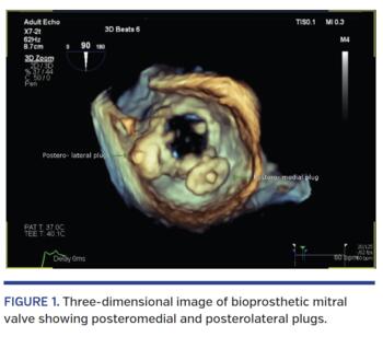 FIGURE 1. Three-dimensional image of bioprosthetic mitral valve showing posteromedial and posterolateral plugs.