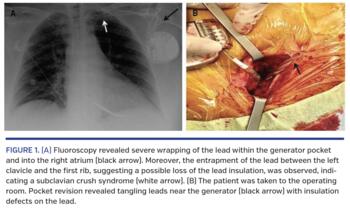 (A) Fluoroscopy revealed severe wrapping of the lead within the generator pocket and into the right atrium (black arrow). Moreover, the entrapment of the lead between the left clavicle and the first rib, suggesting a possible loss of the lead insulation, was observed, indicating a subclavian crush syndrome (white arrow). (B) The patient was taken to the operating room. Pocket revision revealed tangling leads near the generator (black arrow) with insulation defects on the lead.