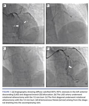 (a) Angiography showing diffuse calcified 80%-90% stenosis in the left anterior descending (LAD) and diagonal branch (D) bifurcation. (b) The LAD artery underwent rotational atherectomy with the 1.5 mm burr. (c) The first diagonal underwent rotational atherectomy with the 1.5 mm burr. (d) Arteriovenous fistula (arrow) arising from the diagonal draining into the accompanying vein.