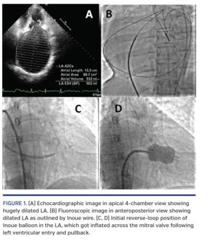 (A) Echocardiographic image in apical 4-chamber view showing hugely dilated LA. (B) Fluoroscopic image in anteroposterior view showing dilated LA as outlined by Inoue wire. (C, D) Initial reverse-loop position of Inoue balloon in the LA, which got inflated across the mitral valve following left ventricular entry and pullback.