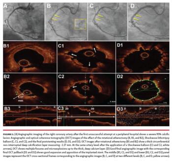 Angiographic imaging of the right coronary artery after the first unsuccessful attempt at a peripheral hospital shows a severe 95% calcific lesion