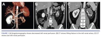 x(A) Angiotomography shows decreased left renal perfusion. (B) CT shows filling failure in the left renal artery. (C) CT shows low left renal perfusion.