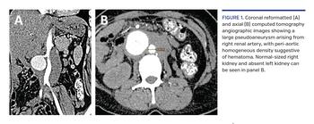 Coronal reformatted (A) and axial (B) computed tomography angiographic images showing a large pseudoaneurysm arising from right renal artery, with peri-aortic homogeneous density suggestive of hematoma. Normal-sized right kidney and absent left kidney can be seen in panel B.