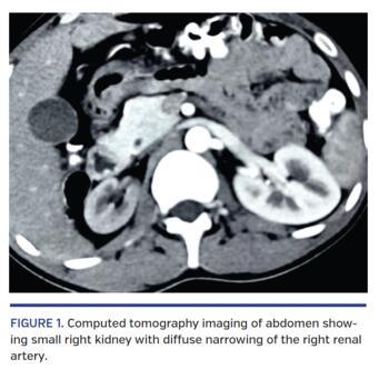 Computed tomography imaging of abdomen showing small right kidney with diffuse narrowing of the right renal artery.